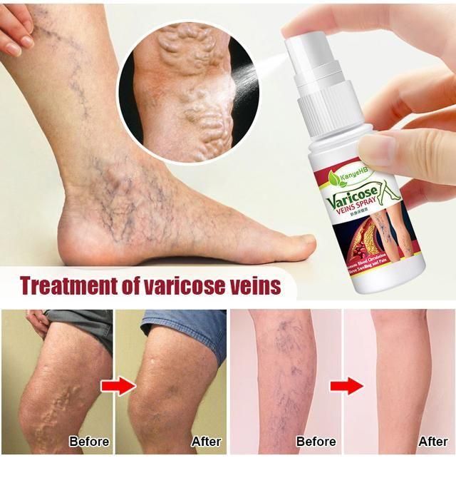 Vein Healing Varicose Veins Treatment Spray 50ml